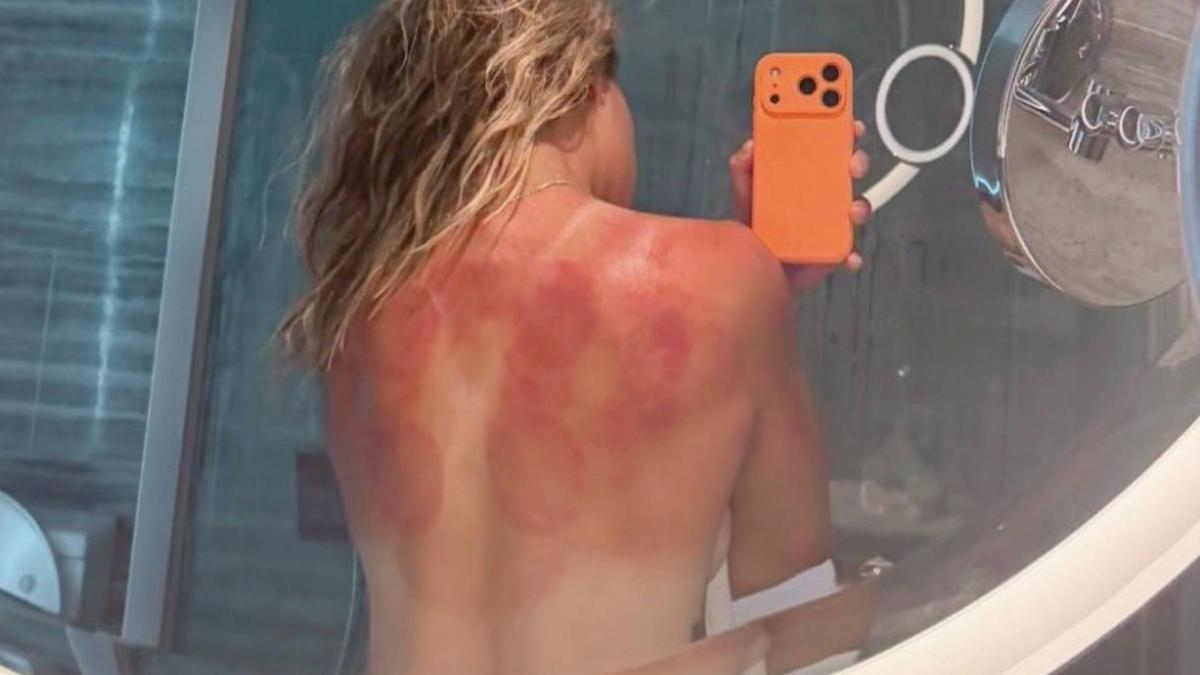 Teniserka joj skida spaljena leđa kako bi upozorila na opasnost od sunca u Australiji