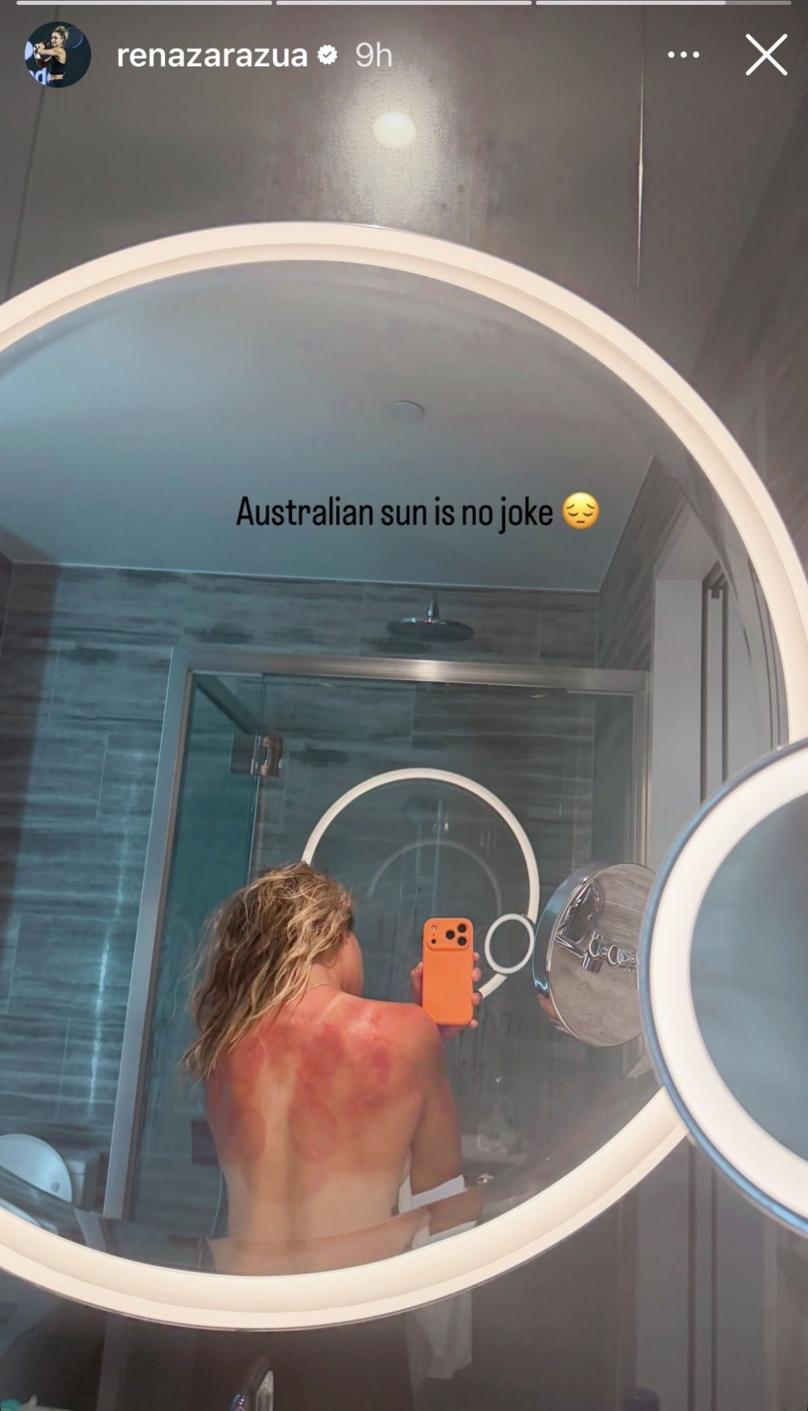 Teniserka Renata Zarazua skida joj spaljena leđa kako bi upozorila na opasnost od sunca u Australiji